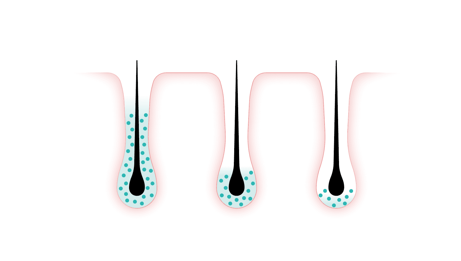 Three follicles side by side. Precision Dutasteride fills the follicle with dutasteride to 0.64; a standard liposome reaches 0.27 at the bulb; the mineral-oil control 0.24.