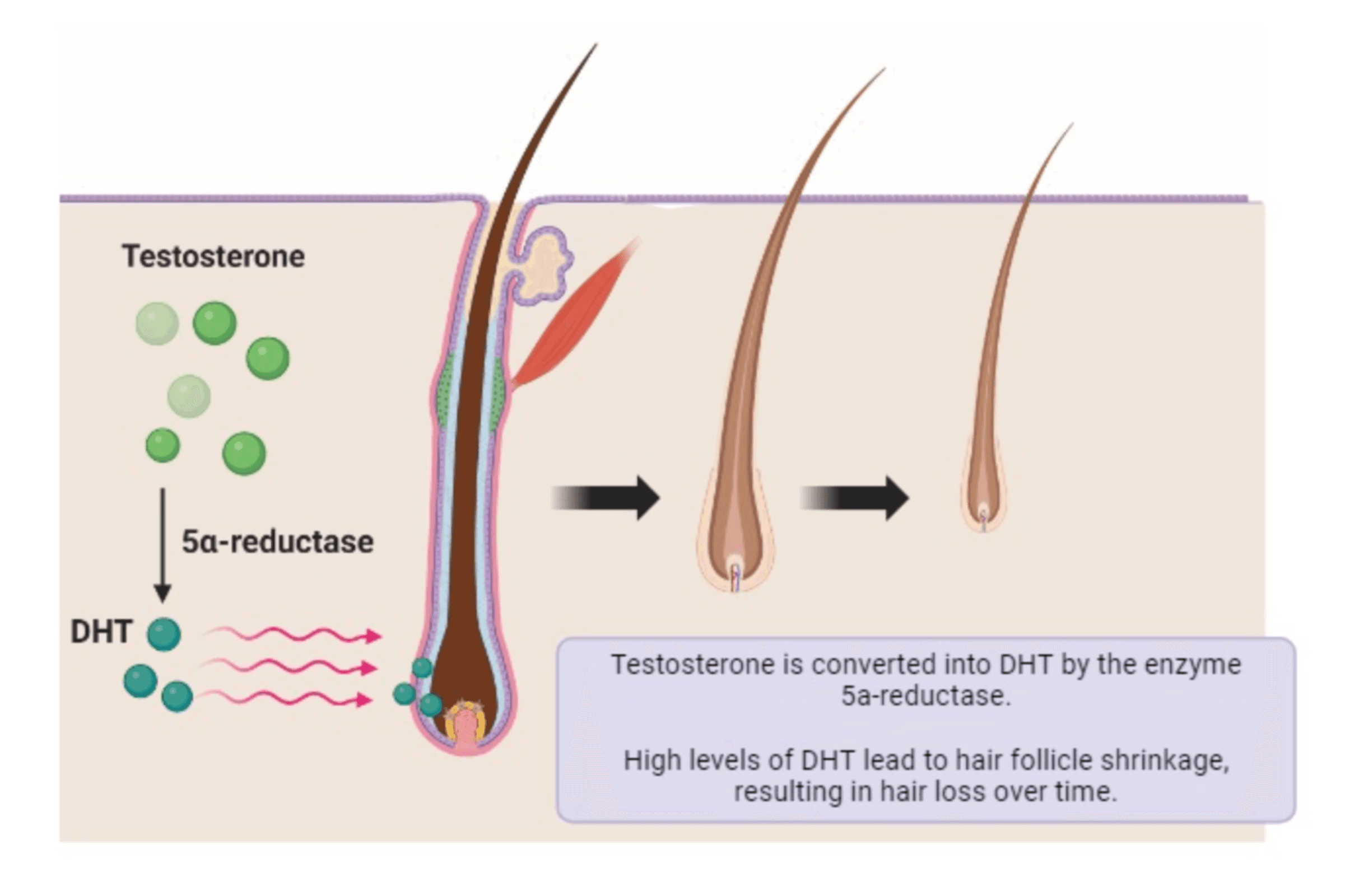 follicle being miniaturized by dht