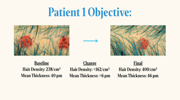 Patient 1 trichoscopy, baseline versus final. Hair density 238 per square centimeter at baseline rising to 400 (a change of plus 162), and mean hair thickness 40 µm rising to 46 µm (a change of plus 6 µm).