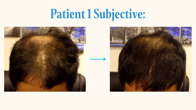 Patient 1 crown photographs before and after six months of topical T3, showing visibly increased coverage and density at the crown and frontal scalp.