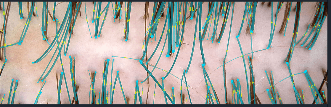 A trichoscopic image of a scalp at high magnification, with every hair shaft outlined and measured by the analysis software.