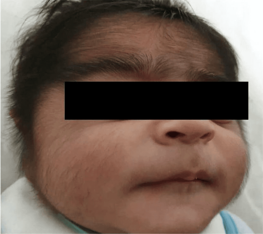Published case report: generalised hypertrichosis in an infant treated with oral diazoxide. The face is masked in the source publication.