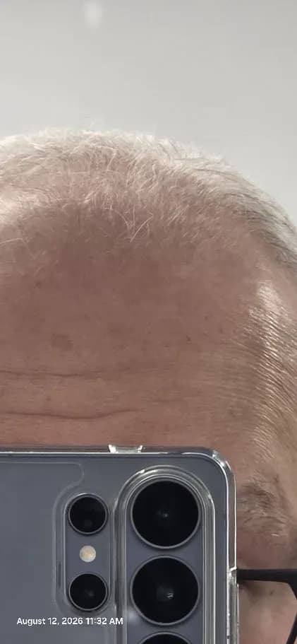 Gandalfpr's scalp coverage in August