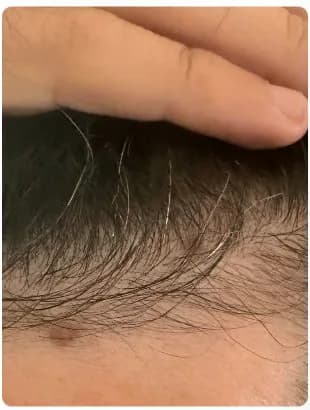 sohailinho's hairline before starting MINX