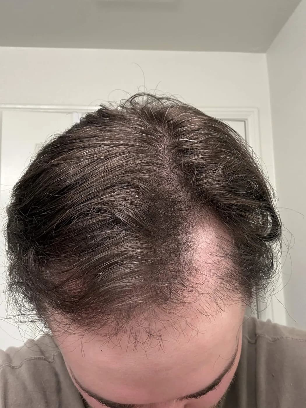 soybugman's frontal hairline after starting MINX
