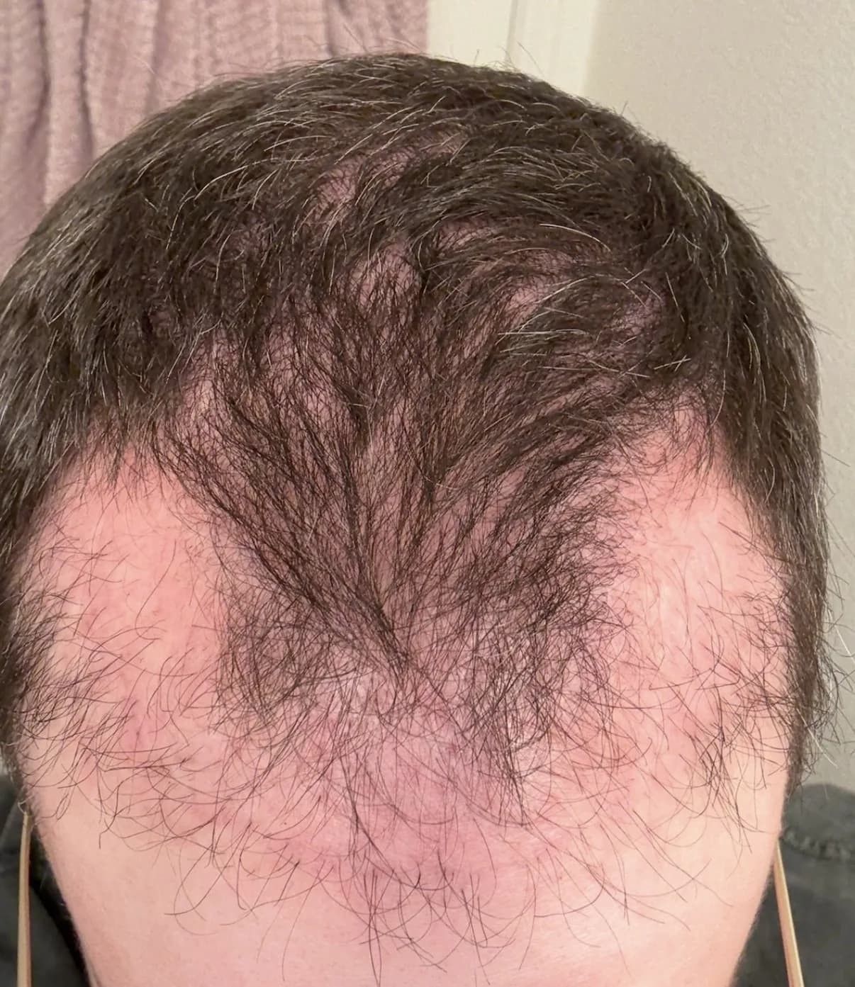soybugman's frontal hairline before starting MINX